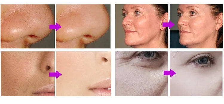 Ultrasonic Skin Scrubber Deep Facial Cleaner Ion Acne Blackhead Remover Peeling Shovel Cleaner Facial Massager Face Lift Machine